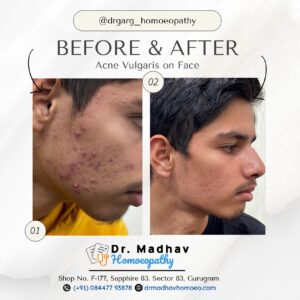 Before and after photos of a 16-year-old Gurugram teen’s Acne Vulgaris cleared with homoeopathy at Dr. Madhav Garg Clinic | Best homeopathy doctor in Gurugram 