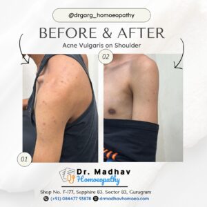 Before and after photos of a 16-year-old Gurugram teen’s Acne Vulgaris cleared with homoeopathy at Dr. Madhav Garg Clinic | Best homeopathy doctor in Gurugram 